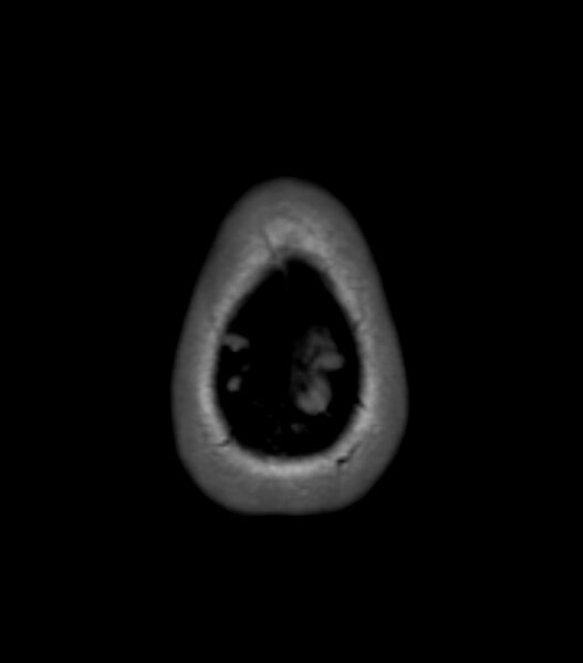 File:Choroid plexus carcinoma (Radiopaedia 91013-108553 Axial T1 159).jpg