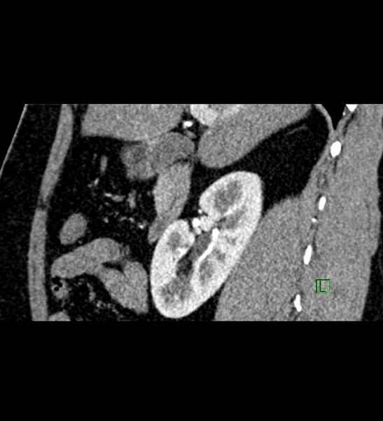 File:Chromophobe renal cell carcinoma (Radiopaedia 84286-99573 F 112).jpg