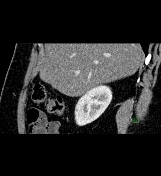 File:Chromophobe renal cell carcinoma (Radiopaedia 84286-99573 F 134).jpg