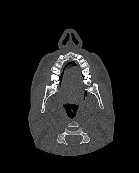 File:Chronic maxillary sinusitis caused by a foreign body (Radiopaedia 58521-65676 Axial bone window 13).jpg