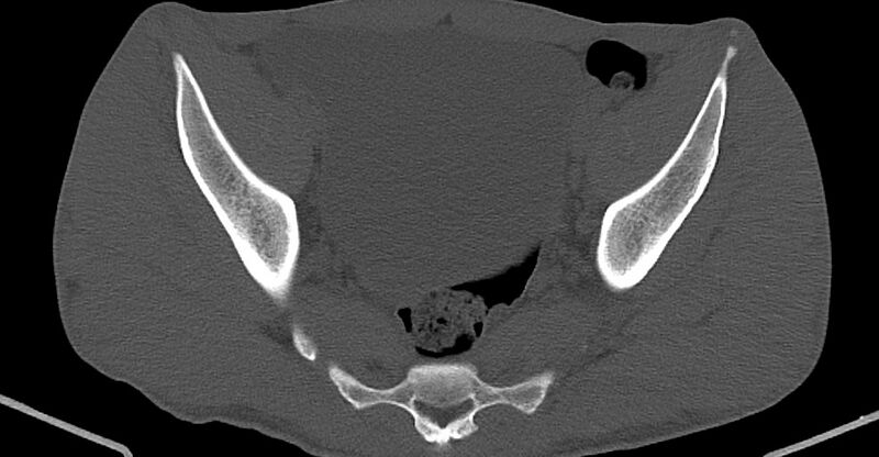 File:Chronic osteomyelitis (with sequestrum) (Radiopaedia 74813-85822 Axial non-contrast 20).jpg