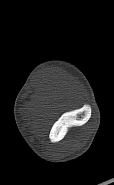 File:Chronic osteomyelitis of the distal humerus (Radiopaedia 78351-90971 Axial bone window 80).jpg
