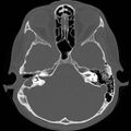 Chronic otomastoiditis (Radiopaedia 27138-27309 Axial bone window 38).jpg