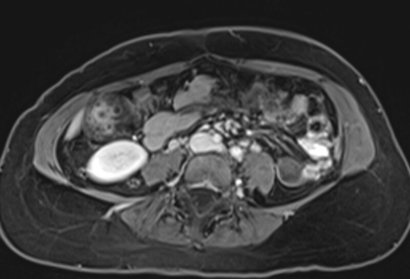 File:Chronic pancreatitis - pancreatic duct calculi (Radiopaedia 71818-82250 Axial T1 C+ fat sat 53).jpg