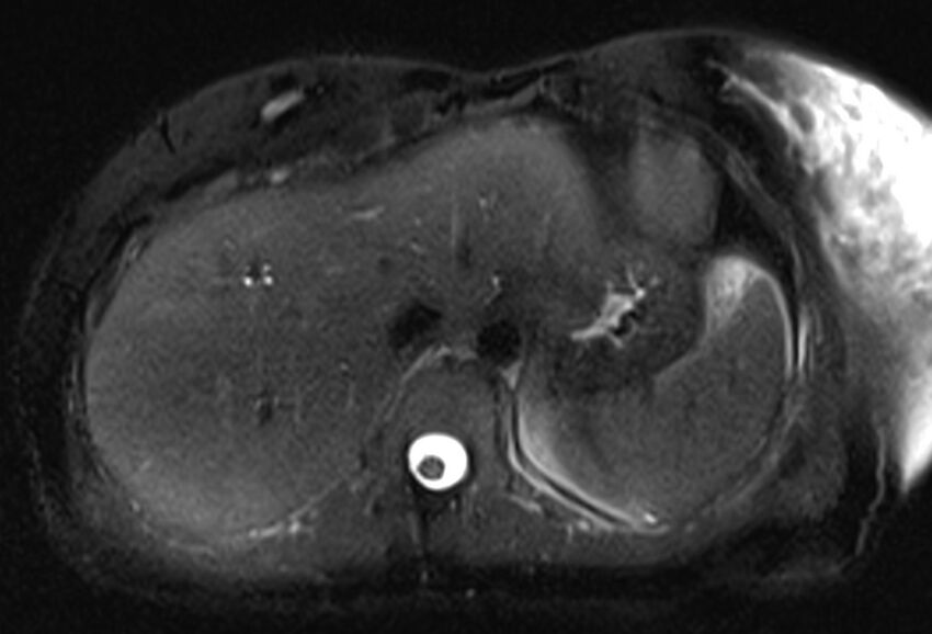 Chronic pancreatitis - pancreatic duct calculi (Radiopaedia 71818-82250 Axial T2 fat sat 11).jpg
