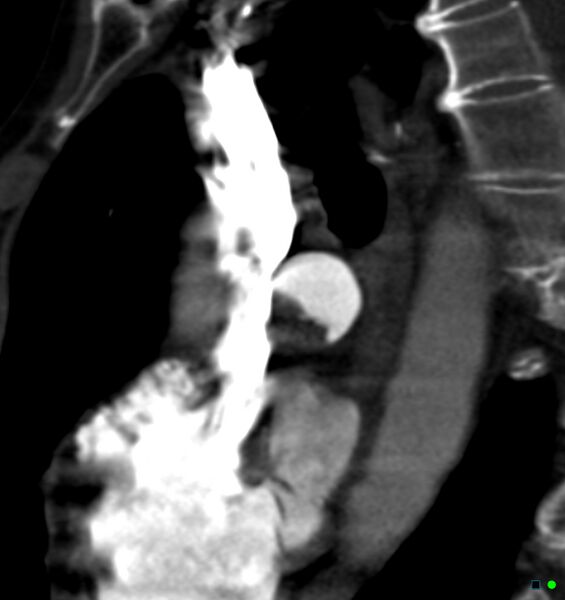 File:Chronic pulmonary embolism (Radiopaedia 17943-17702 Sagittal C+ CTPA 9).jpg