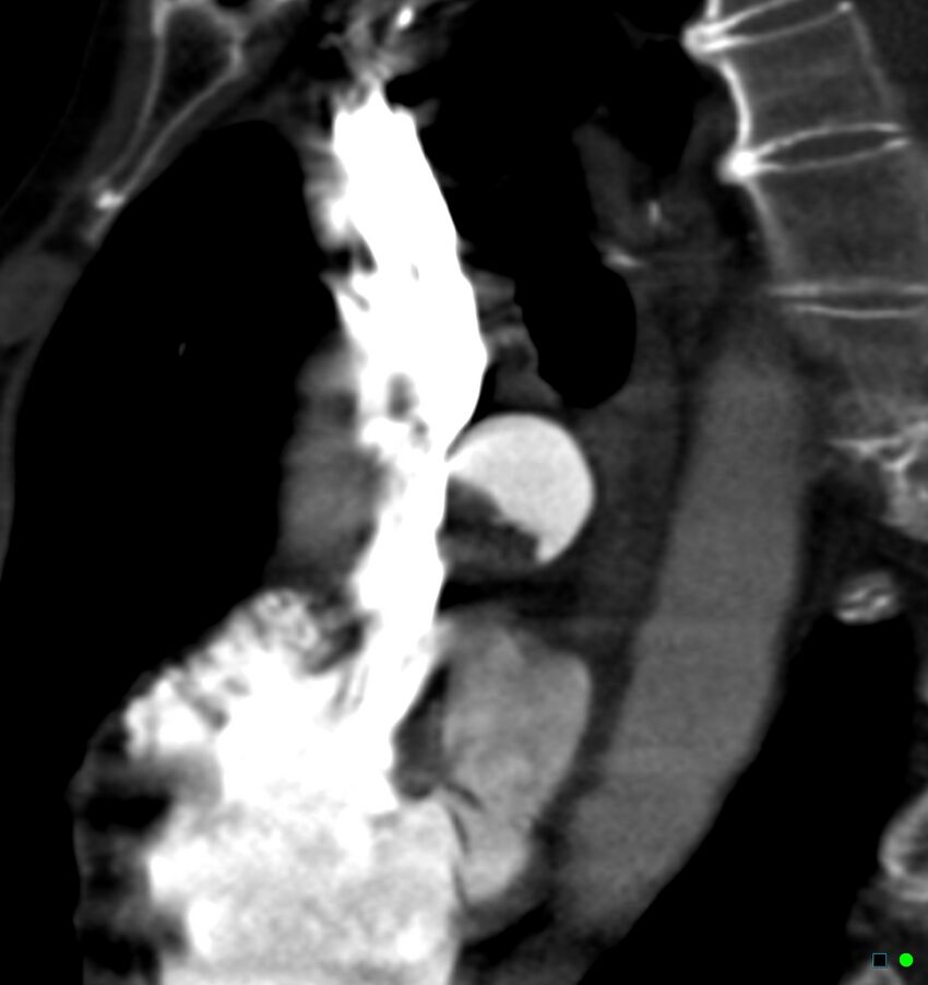 Chronic pulmonary embolism (Radiopaedia 17943-17702 Sagittal C+ CTPA 9).jpg