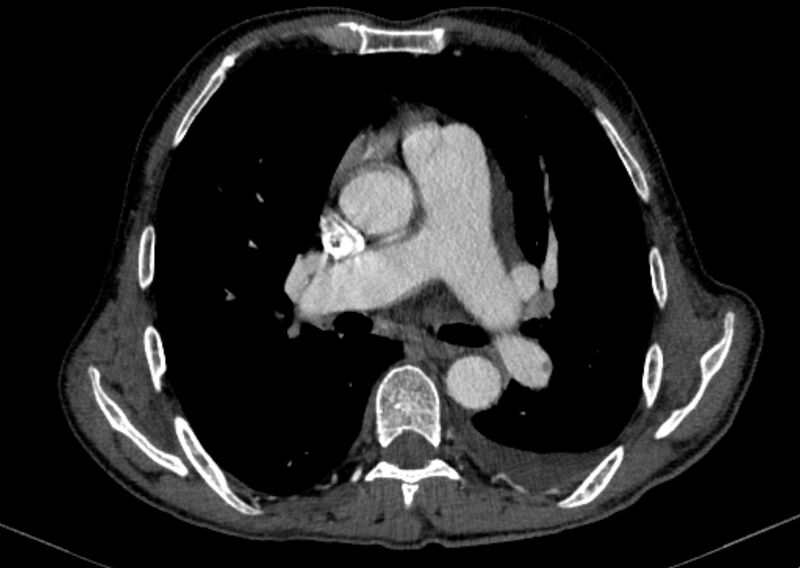 File:Chronic pulmonary embolism with bubbly consolidation (Radiopaedia 91248-108850 C+ arterial phase 72).jpg