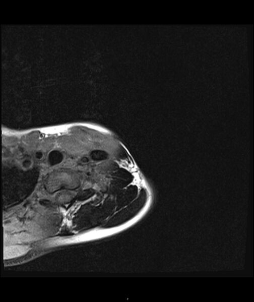 File:Chronic reactive multifocal osteomyelitis (CRMO) - clavicle (Radiopaedia 56406-63071 Axial T1 fat sat 2).jpg