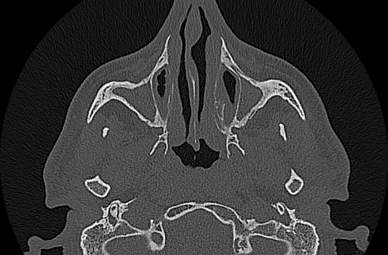 File:Chronic rhinosinusitis (Radiopaedia 65079-74075 Axial bone window 24).jpg