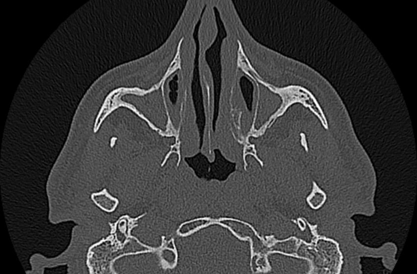 Chronic rhinosinusitis (Radiopaedia 65079-74075 Axial bone window 24).jpg