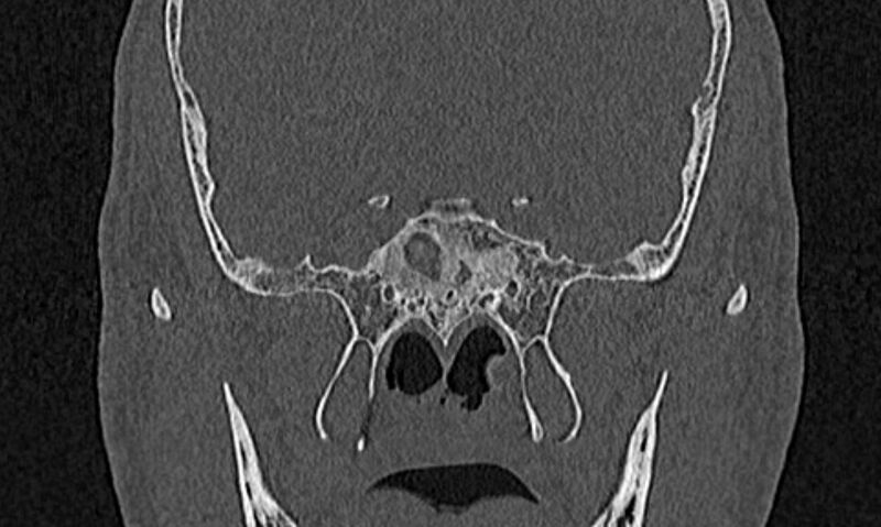 File:Chronic rhinosinusitis (Radiopaedia 65079-74075 Coronal bone window 71).jpg