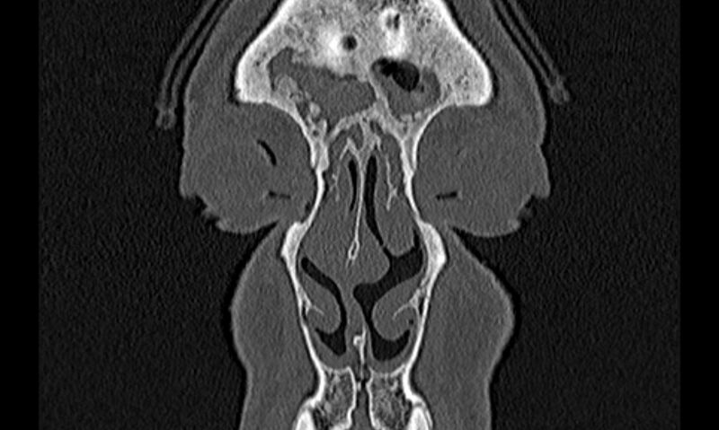 File:Chronic rhinosinusitis (Radiopaedia 65079-74075 Coronal bone window 8).jpg