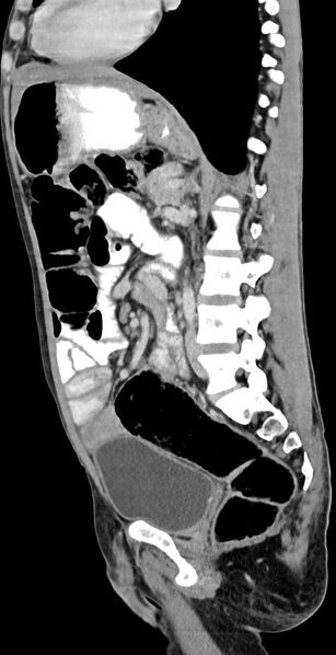 File:Chronic small bowel volvulus (Radiopaedia 75224-86322 C 65).jpg