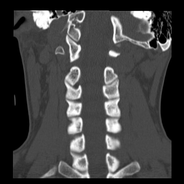 File:Clay-shoveler fracture (Radiopaedia 22568-22590 Coronal bone window 20).jpg
