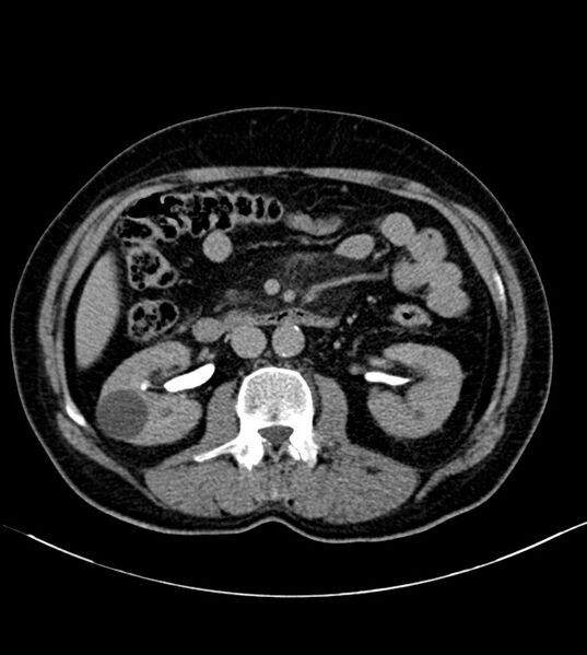 File:Clear cell renal cell carcinoma (Radiopaedia 85006-100539 H 18).jpg