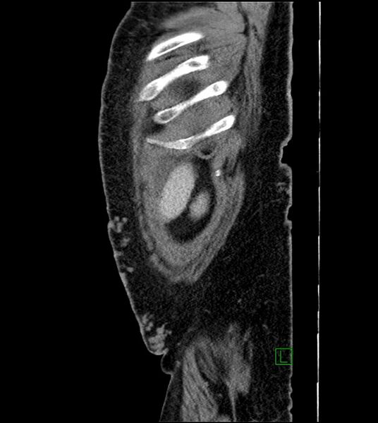 File:Closed-loop small bowel obstruction-internal hernia (Radiopaedia 78439-91096 C 19).jpg