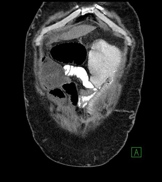 File:Closed-loop small bowel obstruction-internal hernia (Radiopaedia 78439-91096 Coronal non-contrast 22).jpg