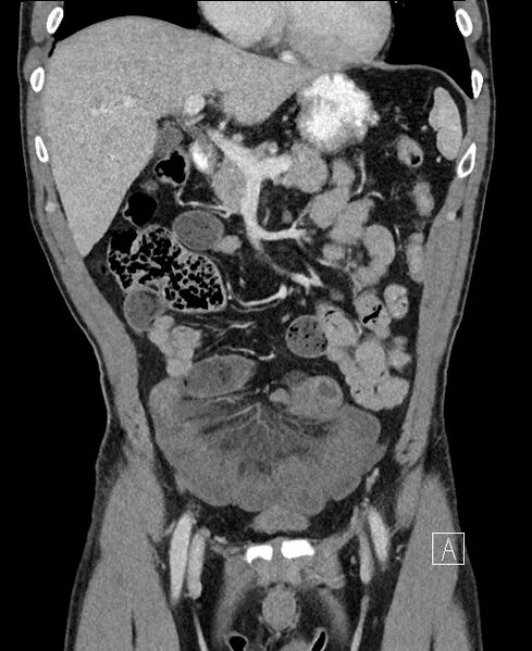 File:Closed loop small bowel obstruction - internal hernia (Radiopaedia 57806-64778 A 40).jpg