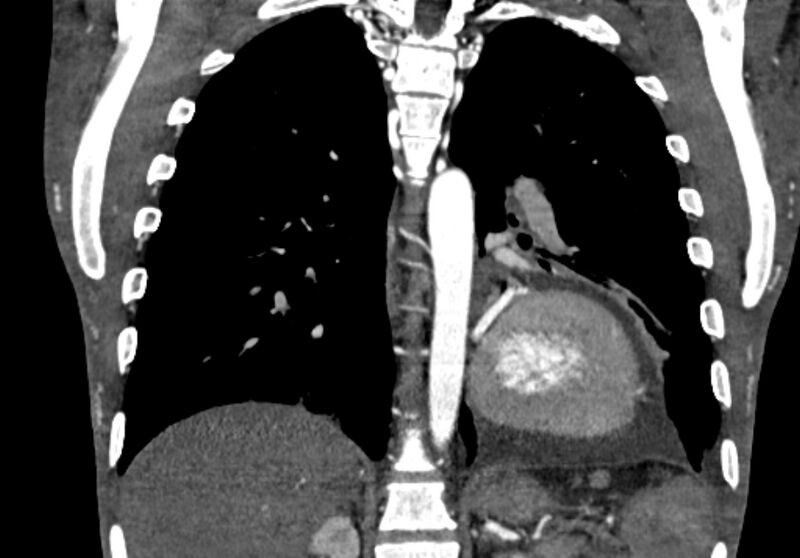 File:Coarctation of aorta with aortic valve stenosis (Radiopaedia 70463-80574 C 165).jpg