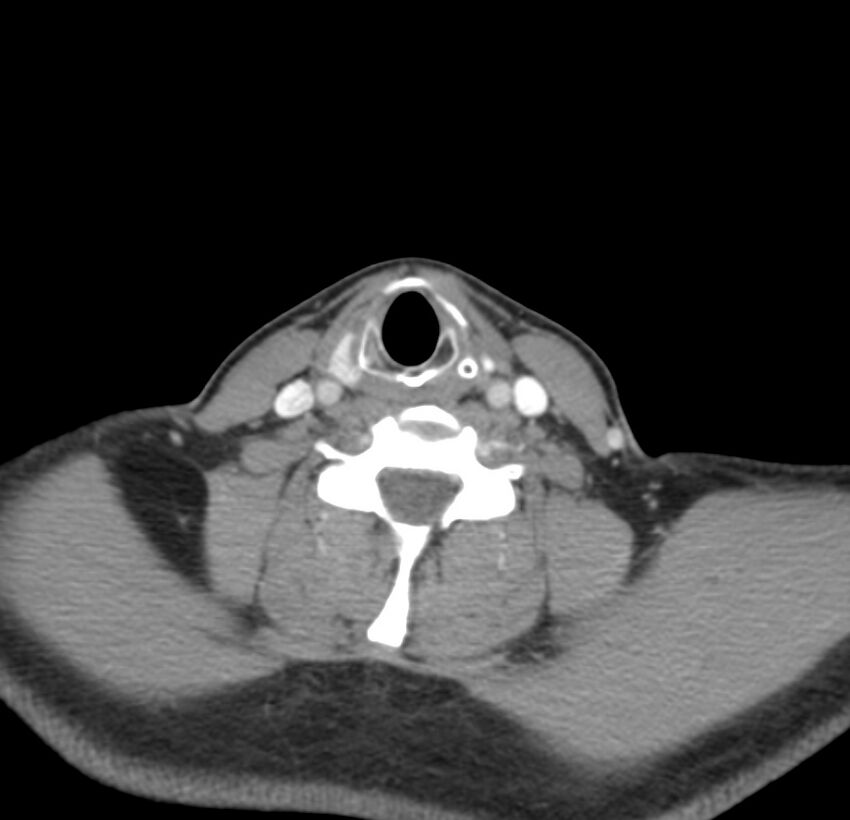 Colloid cyst of thyroid (Radiopaedia 22897-22923 Axial C+ delayed 53).jpg