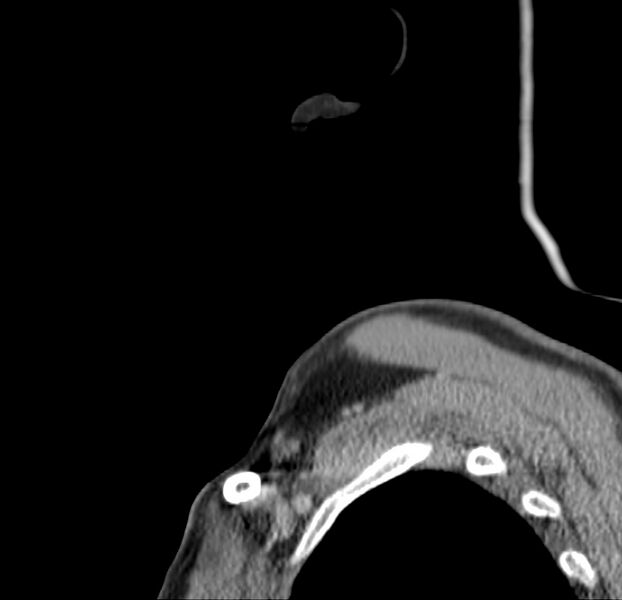 File:Colloid cyst of thyroid (Radiopaedia 22897-22923 Sagittal C+ delayed 1).jpg