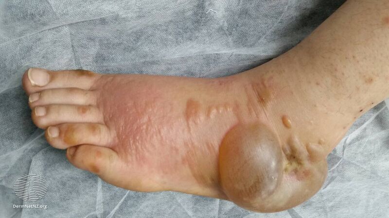File:Hand-foot syndrome due to sorafenib (DermNet NZ HFS-1).jpg