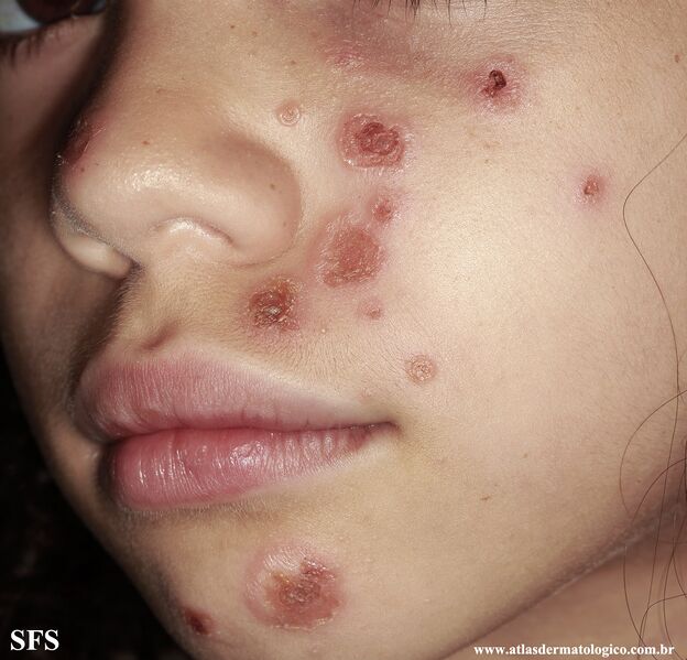 File:Impetigo (Dermatology Atlas 87).jpg