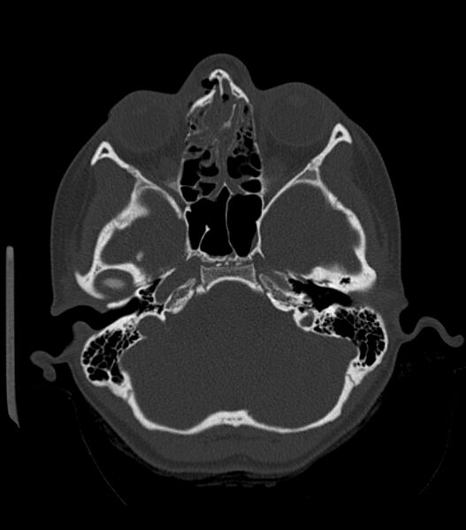 File:Nasoorbitoethmoid fracture (Radiopaedia 90044-107205 Axial bone window 77).jpg