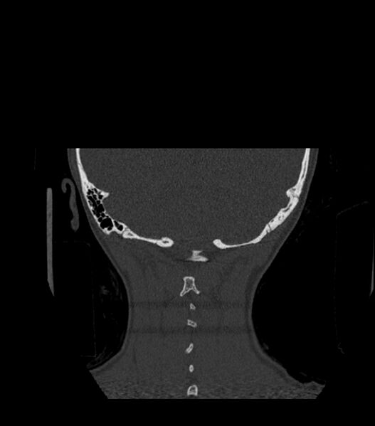 File:Nasoorbitoethmoid fracture (Radiopaedia 90044-107205 Coronal bone window 128).jpg