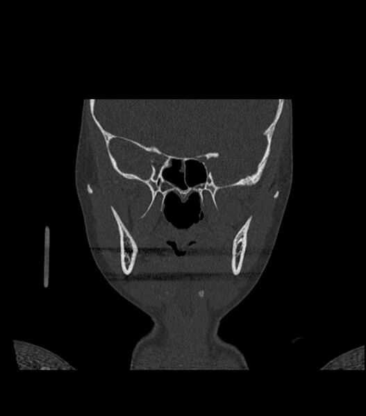 File:Nasoorbitoethmoid fracture (Radiopaedia 90044-107205 Coronal bone window 70).jpg