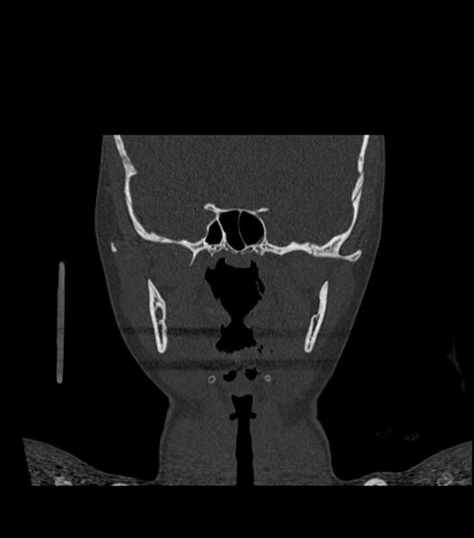 File:Nasoorbitoethmoid fracture (Radiopaedia 90044-107205 Coronal bone window 77).jpg