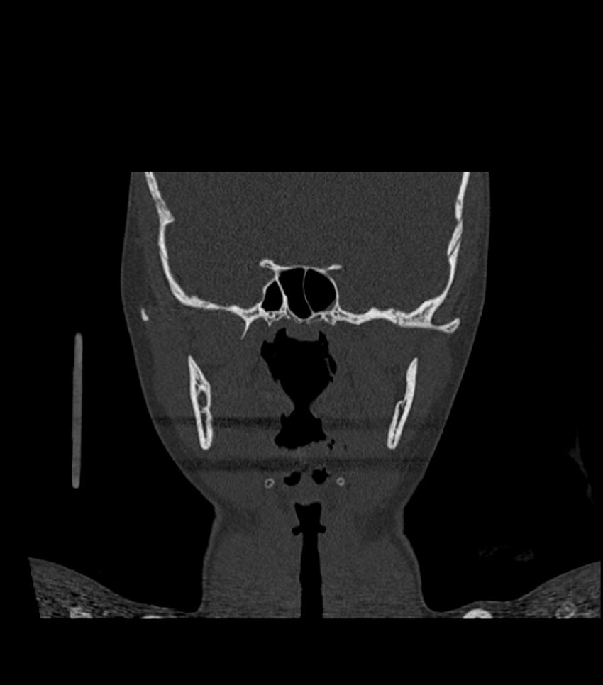 Nasoorbitoethmoid fracture (Radiopaedia 90044-107205 Coronal bone window 77).jpg