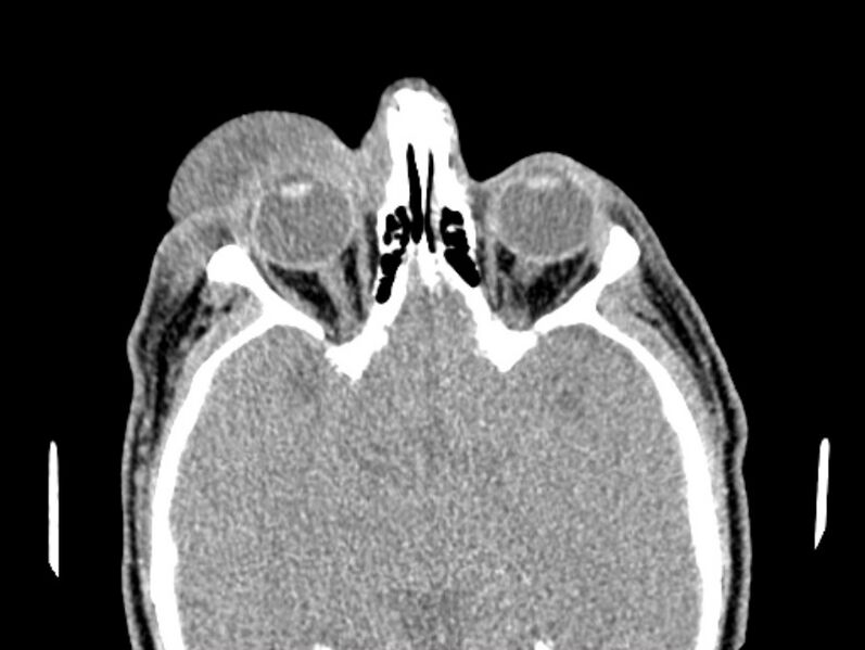 File:Necrobiotic xanthogranuloma- face (Radiopaedia 29549-30052 Axial C+ delayed 3).jpg