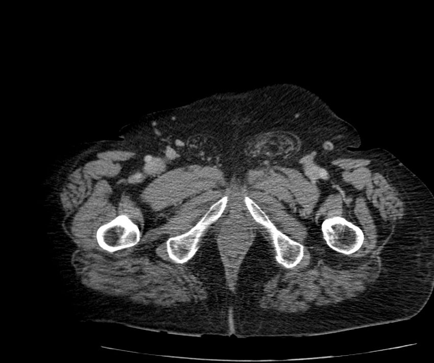Nephroptosis with inguinal hernia containing perirenal fat (Radiopaedia 56632-63391 C 346).jpg
