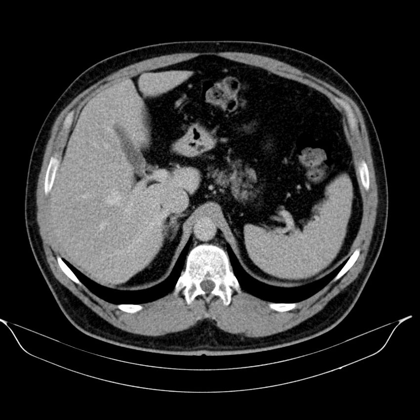 Neuroendocrine tumor of head of pancreas (Radiopaedia 57538-64502 D 23).jpg