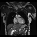 Non-compaction of the left ventricle (Radiopaedia 38868-41062 1CH SSFP CINE 11).jpg