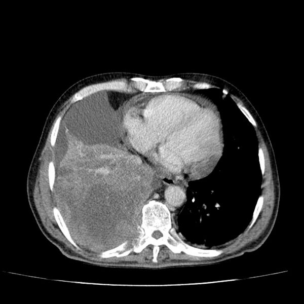 File:Non small-cell lung cancer (Radiopaedia 24467-24769 C+ delayed 43).jpg