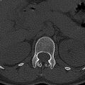 Normal CT lumbar spine (Radiopaedia 53981-60118 Axial bone window 10).jpg