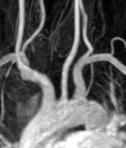 File:Normal MRA of the aortic arch (Radiopaedia 35881).jpg