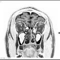 Normal coronal brain (Radiopaedia 6676-7910 B 4).jpg