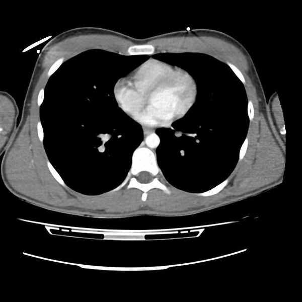 File:Normal dual-phase trauma CT chest,abdomen and pelvis (Radiopaedia 48092-52899 A 34).jpg