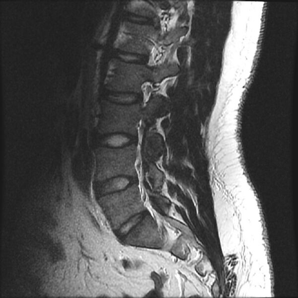 File:Normal lumbar spine MRI (Radiopaedia 43051-46311 Sagittal T2 14).jpg