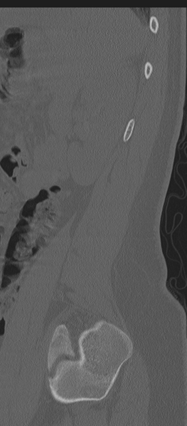 File:Normal lumbosacral CT (Radiopaedia 37923-39867 Sagittal bone window 14).png