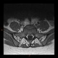 Normal spine MRI (Radiopaedia 77323-89408 Axial T1 25).jpg