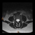 Normal spine MRI (Radiopaedia 77323-89408 Axial T2 10).jpg