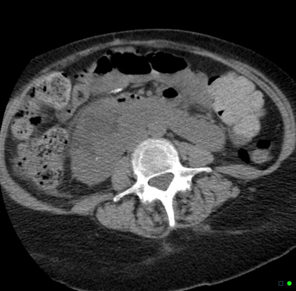 File:Obstructed infected horseshoe kidney (Radiopaedia 18116-17898 non-contrast 17).jpg