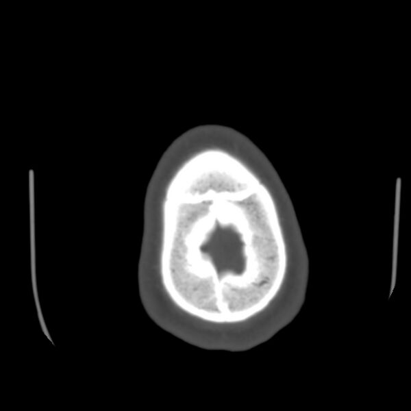 File:Occipital spur - asymptomatic (Radiopaedia 87753-104201 Axial bone window 205).jpg