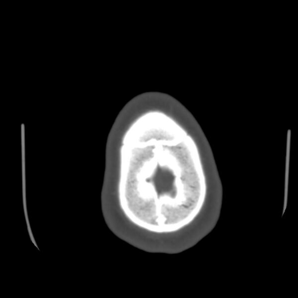File:Occipital spur - asymptomatic (Radiopaedia 87753-104201 Axial bone window 206).jpg