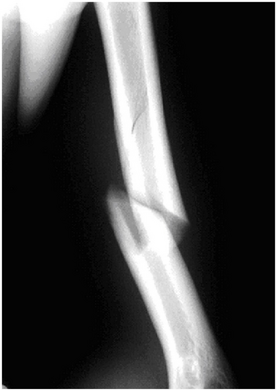 Internal rotation view showing a spiral fracture at junction of middle and distal thirds of humerus.
